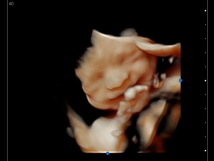 3D Ultrasound of a baby smiling