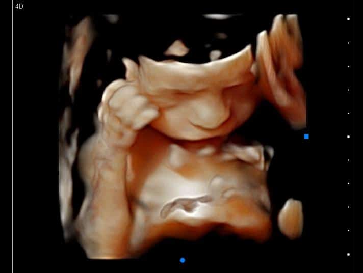 3D ultrasound of a baby touching her head