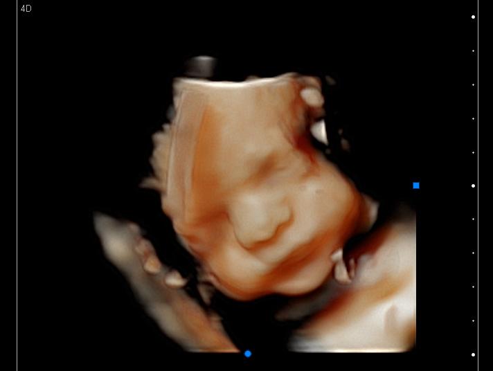 3D ultrasound of a baby looking straight
