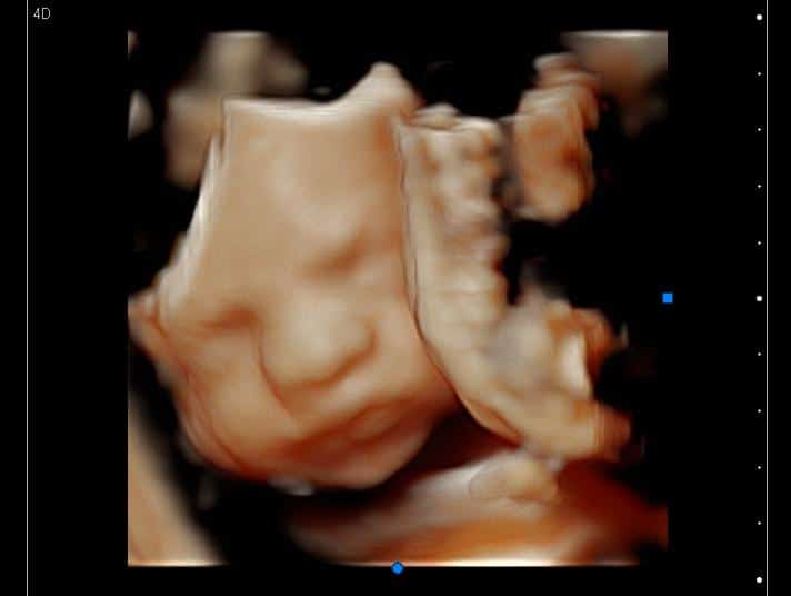 3D ultrasound of a baby frowning