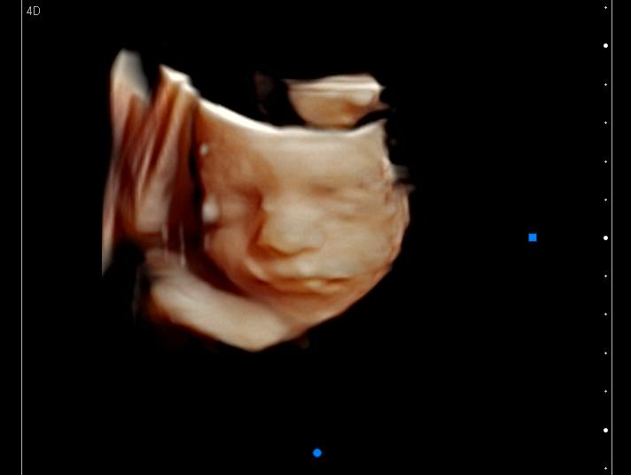 3D ultrasound of a baby smirking