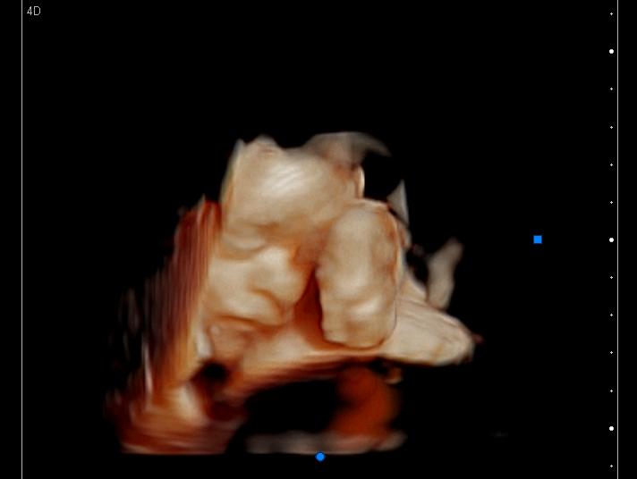 3D ultrasound of a baby looking down