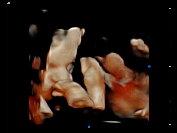 3D ultrasound of a baby sucking their thumb